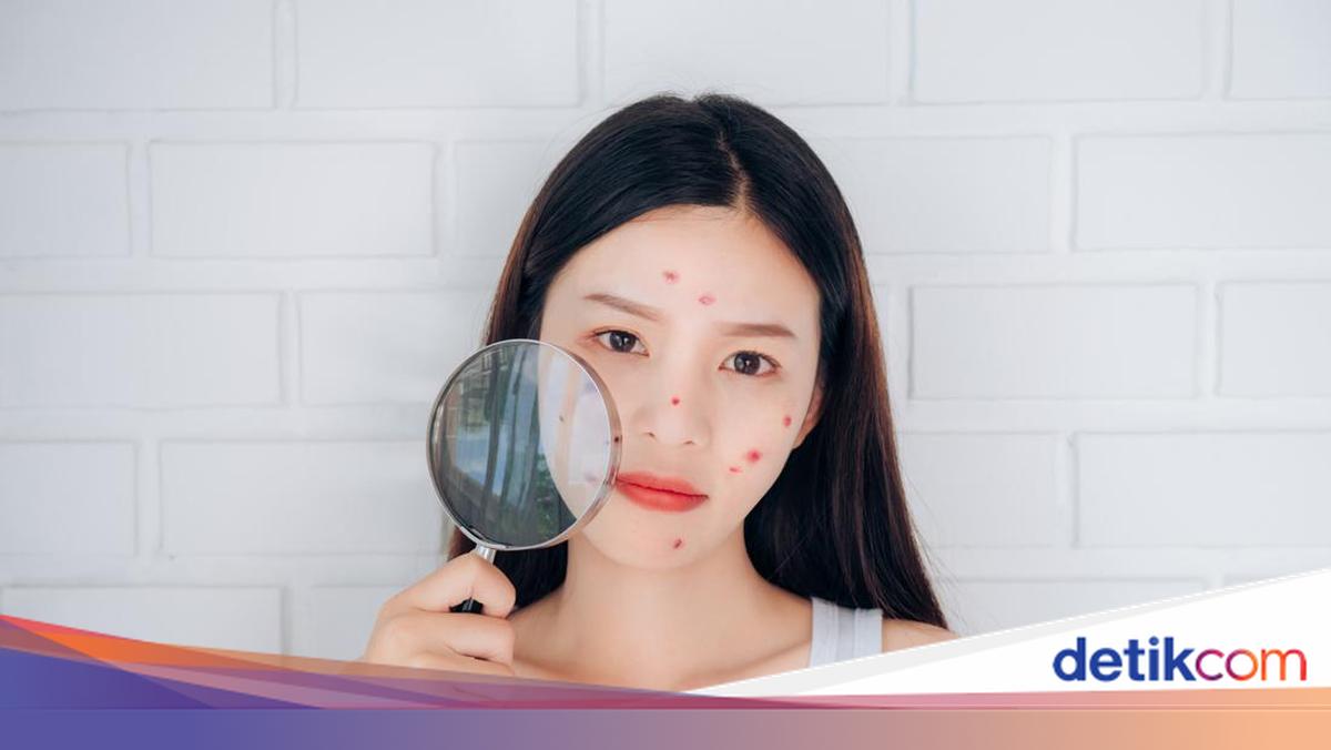Diet untuk Hilangkan Jerawat Viral di TikTok, Ini Pendapat Dermatologist