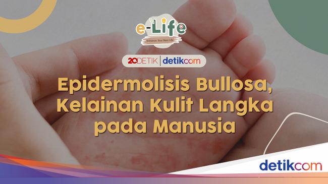 Penyakit Kulit Langka, 'Hanya' ada 66 Pasien di Indonesia