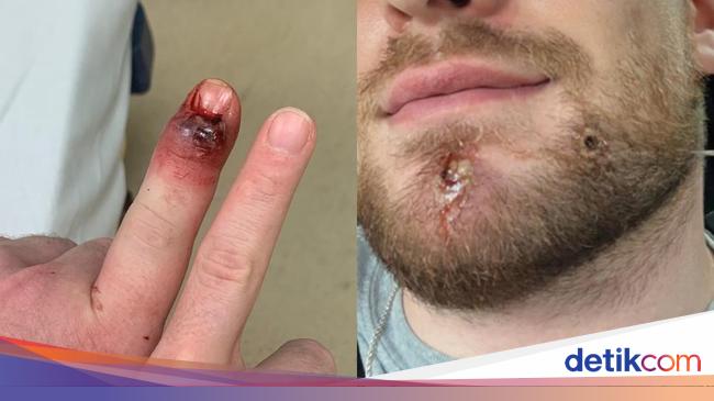 Sores Appears on Fingers, Face, and Mouth