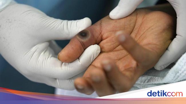 Mpox: Herbal Treatment for Monkey Pox in Jakarta, Banten, and West Java