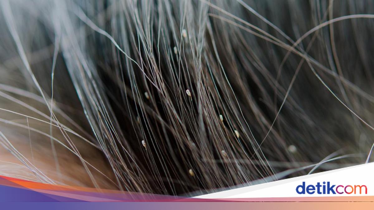 Kutu Kepala Ternyata Bisa Hidup di Rambut Bersih, Ini Penjelasannya
