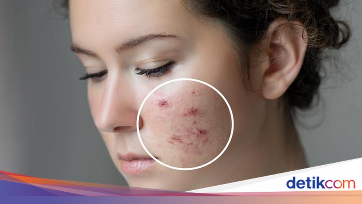 Tak Cuma Skincare, 5 Makanan Ini Efektif Bantu Atasi Jerawat