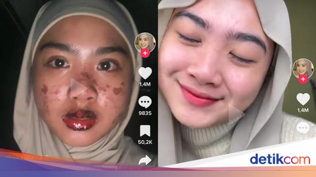 Viral woman Bekasi will get COVID-19 and Stevens Johnson syndrome at the similar time