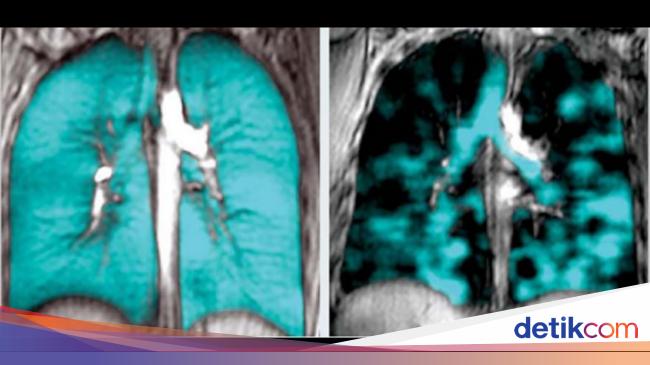 Vapers Sering 'Engap' Saat Bernapas? Studi Temukan Kemungkinan Penyebabnya