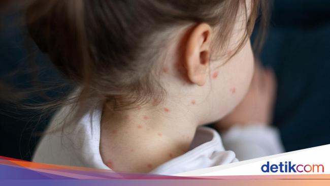 Measles Cases Increase in Indonesia, IDAI Records a 32-Fold Surge!