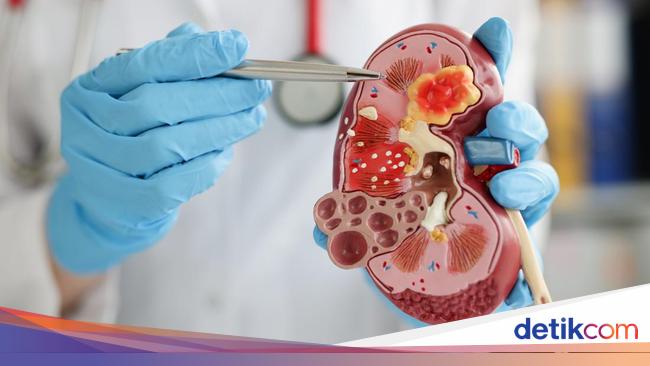 12 Kebiasaan Sehari-hari yang Bisa Bikin Ginjal Rusak Berujung Cuci Darah