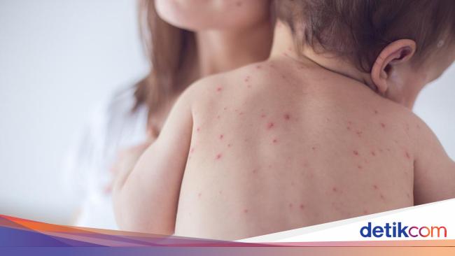 Natural Treatments for Chickenpox: How to Treat and Relieve Symptoms Quickly