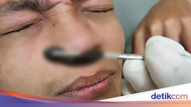 Residents of Bogor at the first suspicion have a leech in their nose