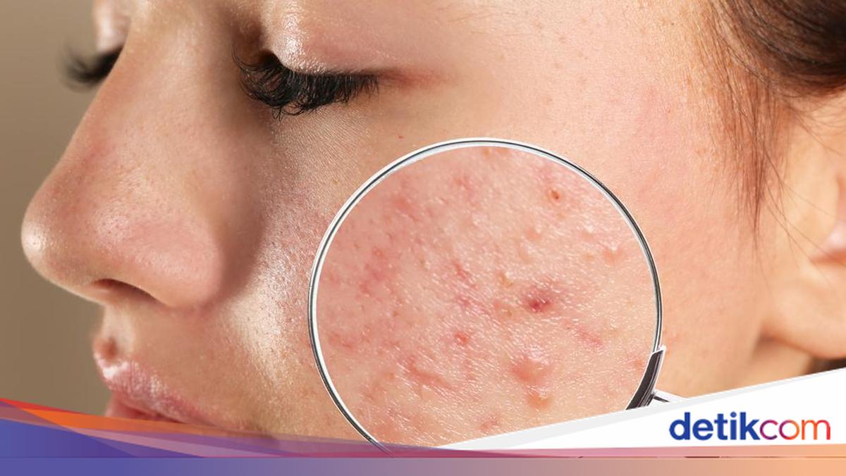Skincare Tak Mempan? Ini Treatment yang Bikin Bekas Jerawat Cepat Pudar