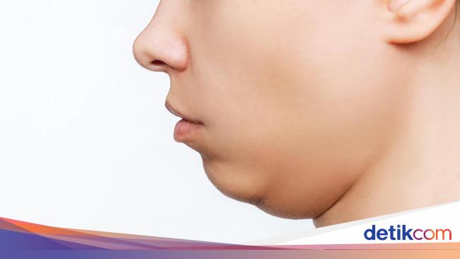 Cara Menghilangkan Double Chin dengan dan Tanpa Operasi