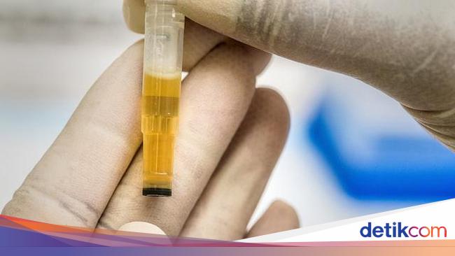 Memahami Arti Protein Urine Positif 1, Apakah Pertanda Buruk?