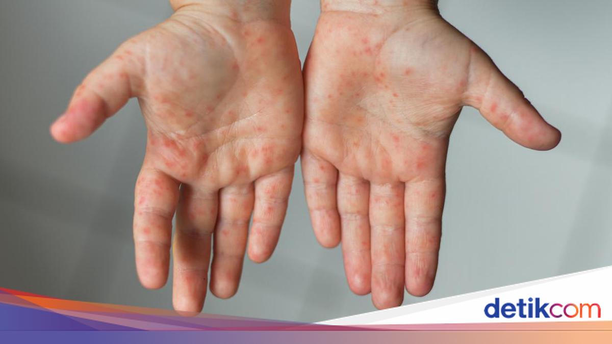 Dinkes Banten Temukan 2.000 Suspek Campak hingga Maret 2026: Mengarah KLB