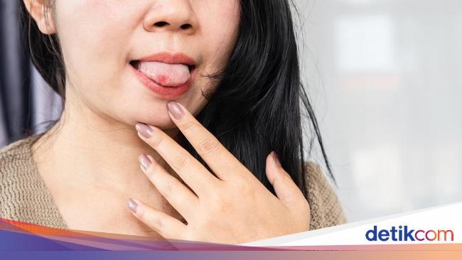 Kenali Penyebab Sariawan di Lidah dan Cara Mengobatinya