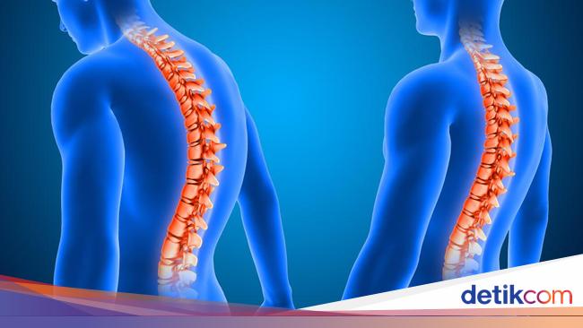 Kelainan pada Tulang: Ciri dan Penanganannya