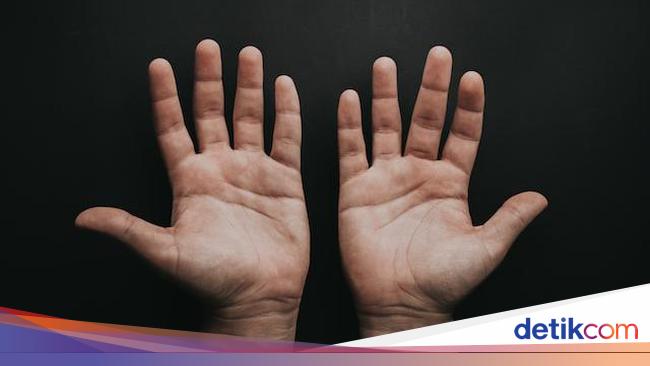 Causes and Treatment of Palmar Hyperhidrosis