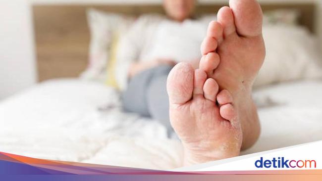 10 Obat Kutu Air Membandel Ketahui Juga Gejala Dan Pencegahannya 2743