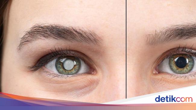 Operasi Katarak Ditanggung BPJS