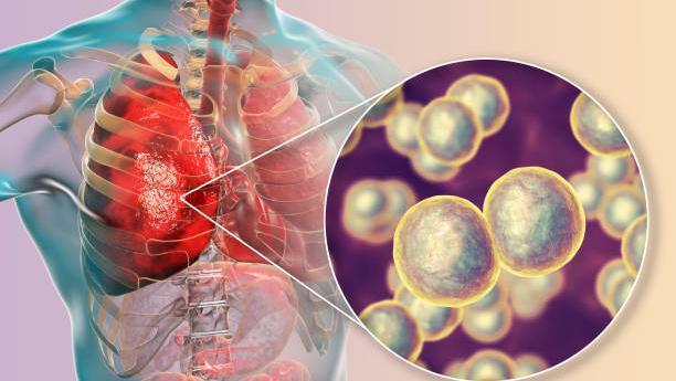 Pneumonia Adalah: Penyebab, Gejala, Cara Mengobati, Dan Pencegahannya