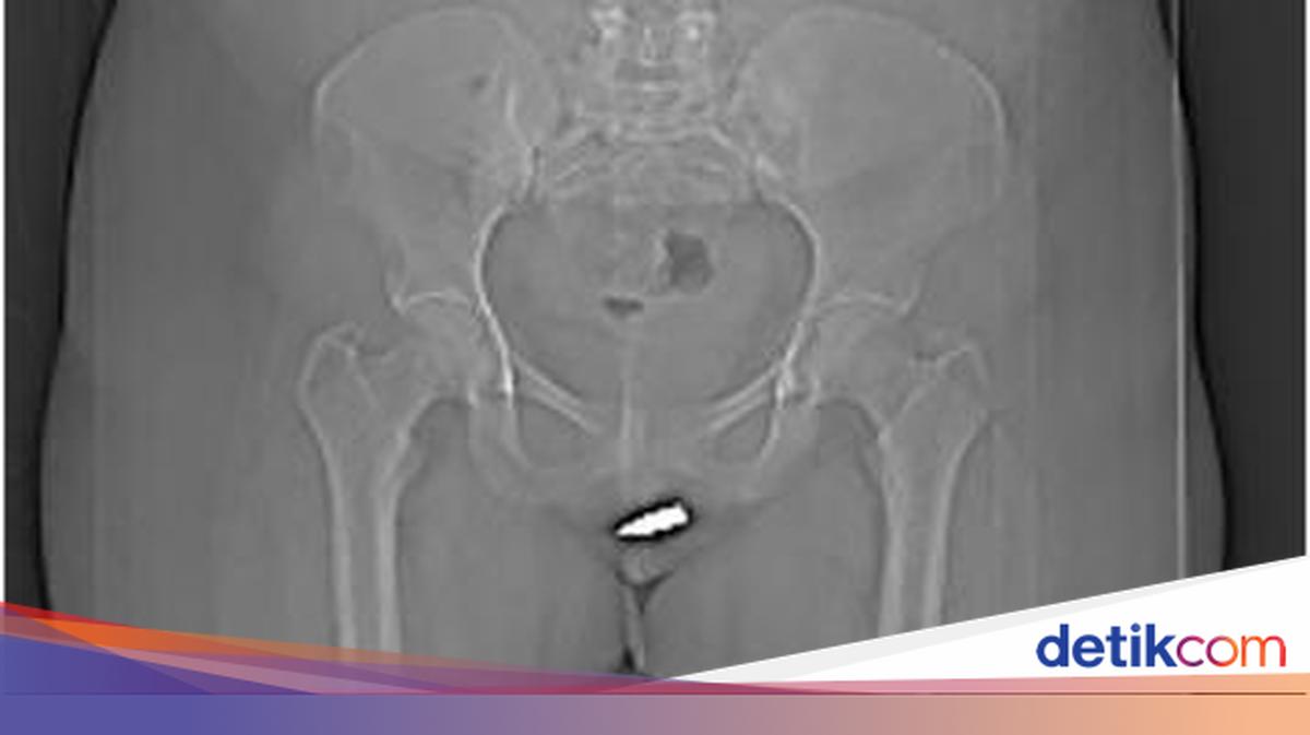 Klitorisning olchami jinsiy olatni fotosurati