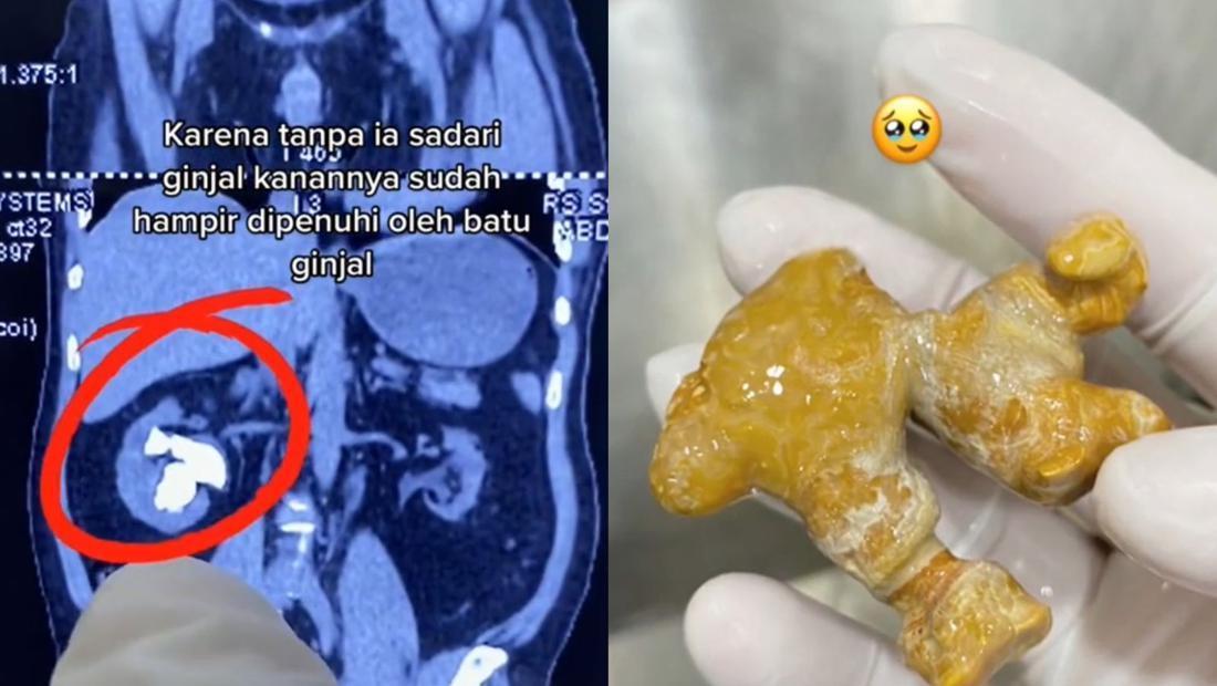 Viral Batu Ginjal Seukuran Jahe, Gegara Doyan Minum Manis-Sering Nahan ...