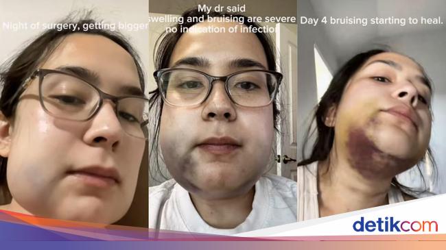 Viral Kisah Wanita Cabut Gigi Bungsu Berujung Rahang Bengkak Dan Memar