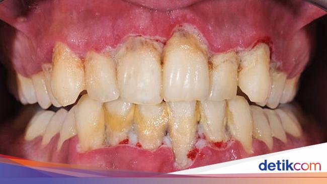 10-cara-menghilangkan-karang-gigi-secara-alami-dan-cepat