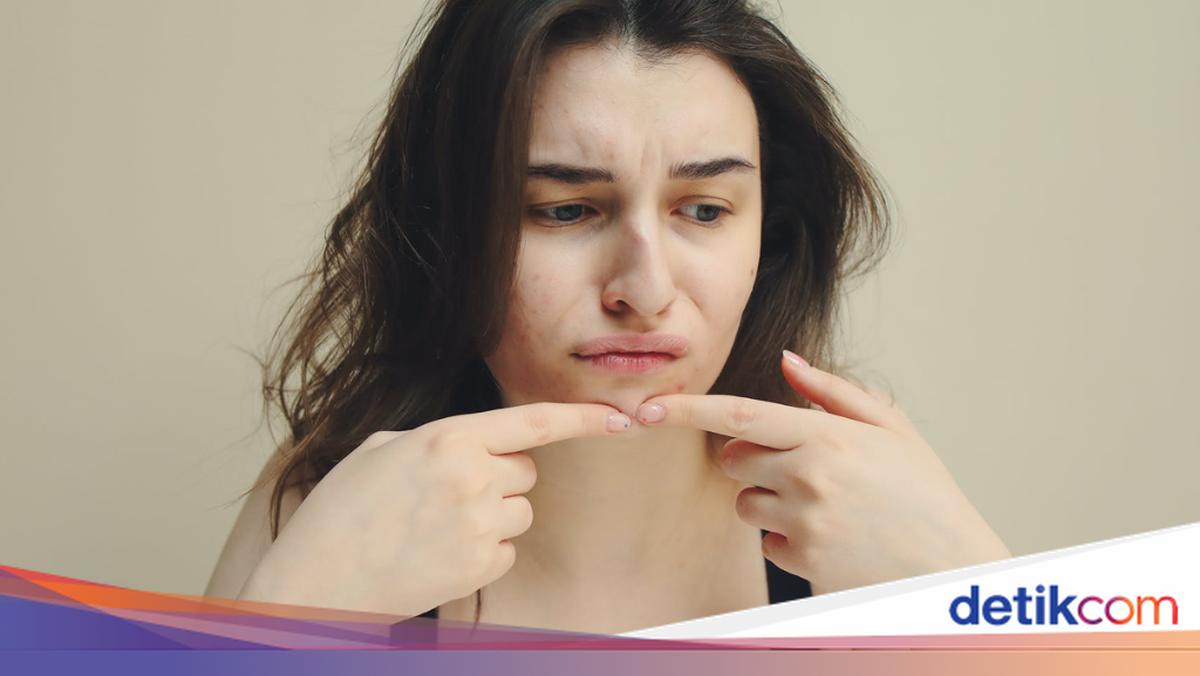 Jerawat Aktif Bikin Kesel? Coba 3 Rekomendasi Treatment ini di ZAP Clinic