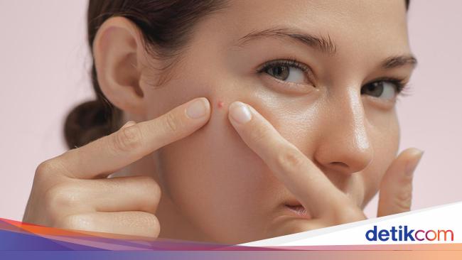 Cara Mengatasi Jerawat Akibat Berhenti Skincare