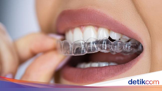 Choosing Aligners for Teeth Straightening: Benefits, Process, and Proper Usage