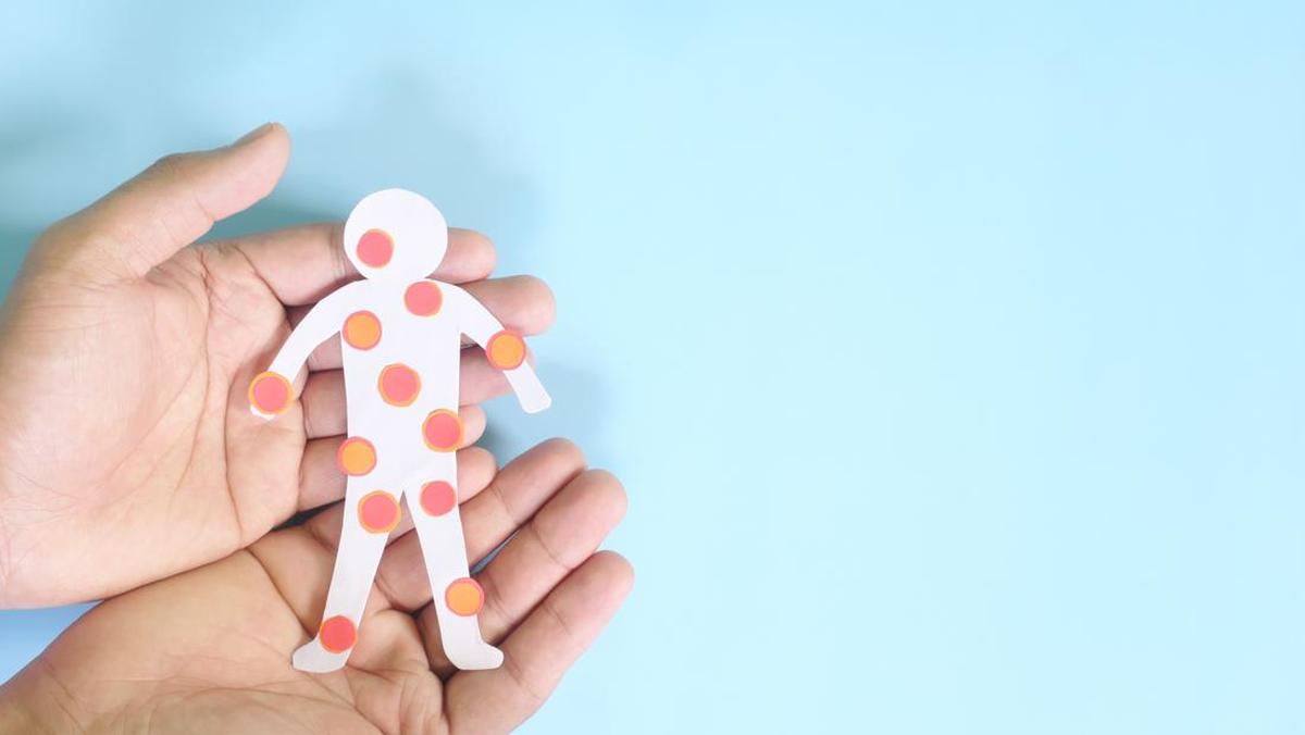 Ingin Cacar Air Cepat Kering? Ini 5 Obat Alami yang Bisa Dicoba