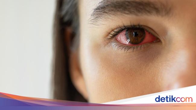 causes-and-remedies-for-red-eyes-medical-and-natural-treatments