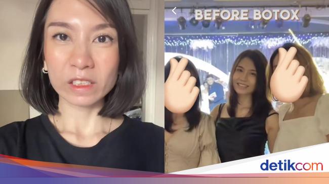 Before-After Viral Wanita Gagal Botox Berujung Tak Bisa Tertawa 4 Bulan
