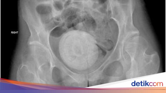 Rare Case of Vaginal Stone in Jakarta: Causes, Symptoms, and Treatment