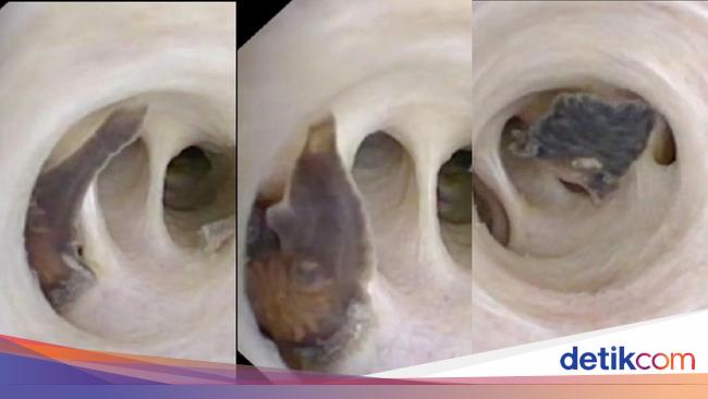 70 Year Old Cancer Patient in Jakarta Found with Parasitic Worms in Body: Shocking Discovery