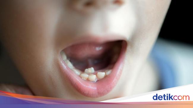 Gigi Nggak Rapi Bisa Bikin Mental Berantakan, Ini Pemicunya Menurut Dokter