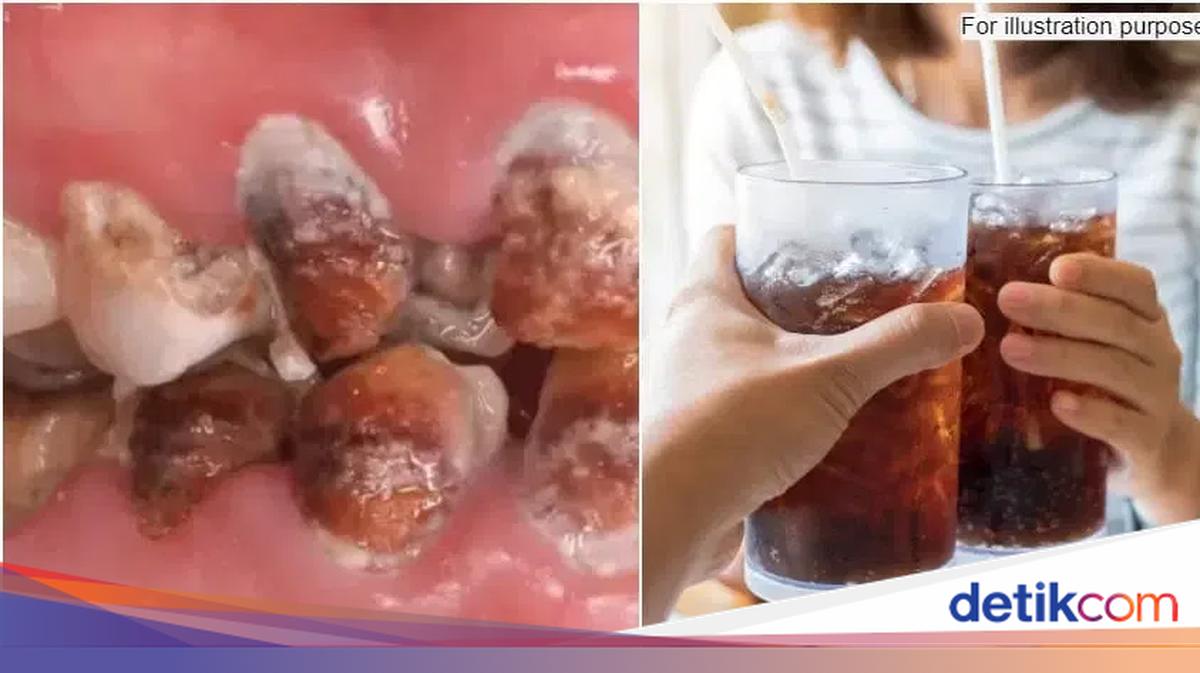 Minum Soda Tiap Hari, Wanita Ini Keluarkan Rp 442 Juta Untuk Obati Giginya