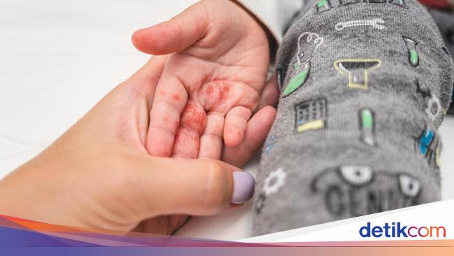 Heboh Imbauan Flu Singapura di Sekolah-sekolah, Dinkes DKI Beberkan Gejalanya