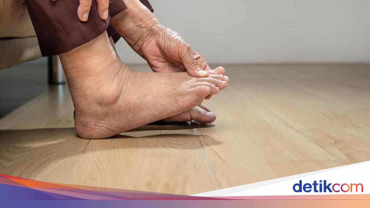 14 Penyebab Kaki Bengkak, Benarkah Gejala Sakit Ginjal?