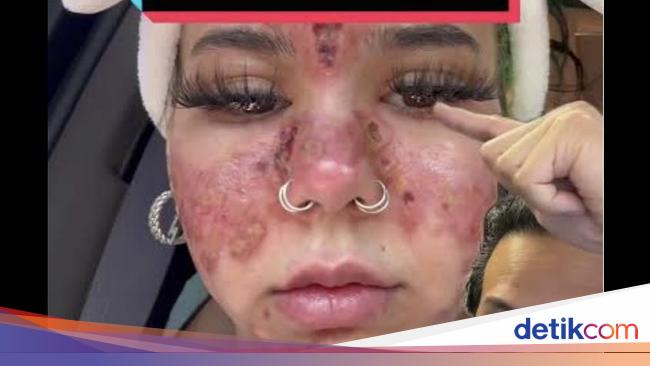 The Risks of Utilizing Outdated Pores and skin Care, Burn This Lady’s Face