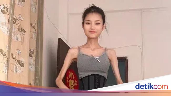 体重仅 25 公斤的网红女子仍想进一步减肥