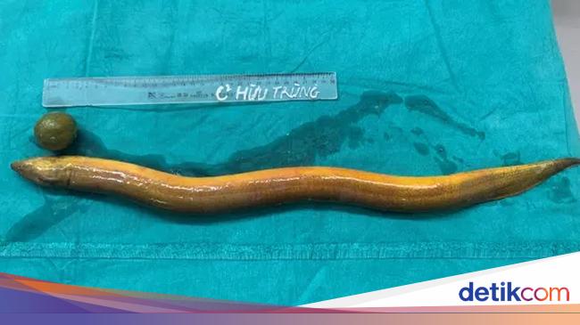 Strangest Medical Cases of 2024: From 3 Penises to Eels in the Gut