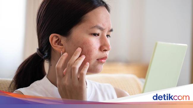 Mengenal Fungal Acne dan Cara Mengatasinya