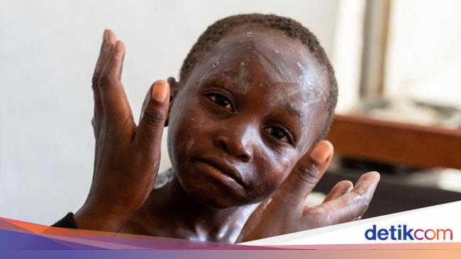 Stories of children affected by Mpox Transmission, Here are the symptoms experienced