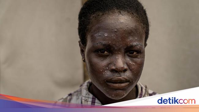 Testimony from doctors in Africa who treat Mpox patients, This is how bad their situation is