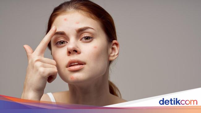 Using Antiseptics to Treat Acne, Is It Really Effective?