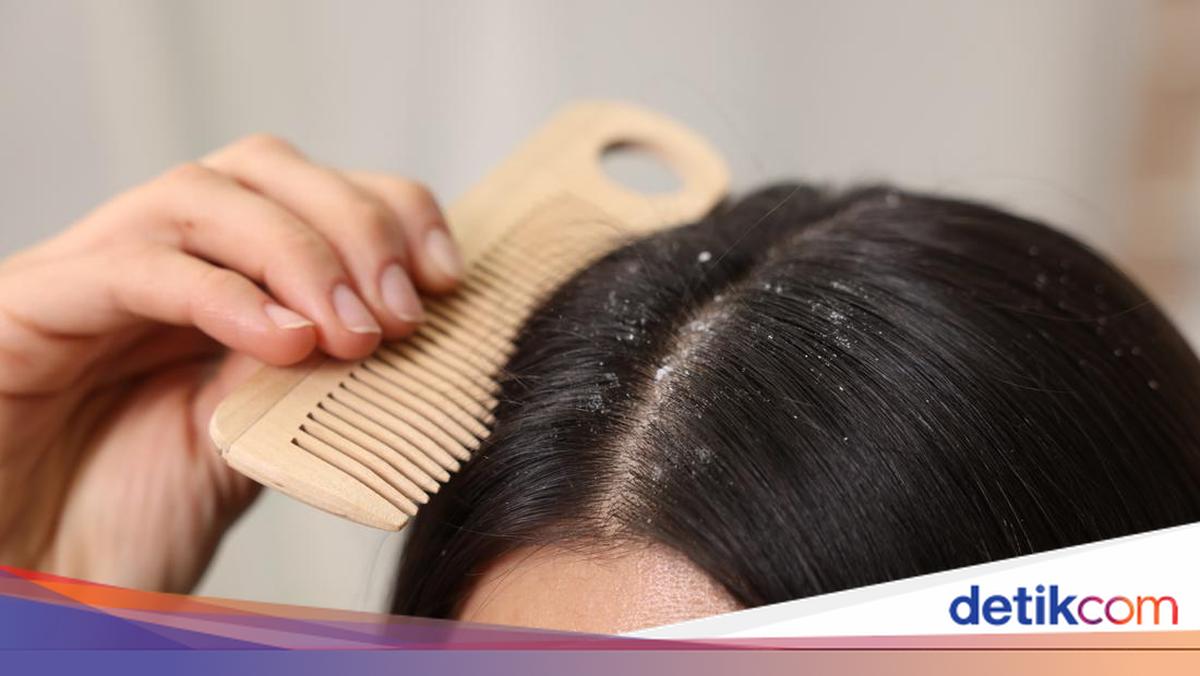 7 Makanan yang Ampuh Lawan Ketombe, Nomor 7 Sering Ada di Dapur!