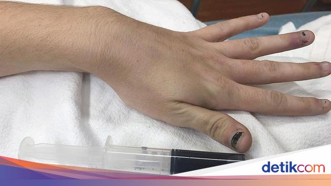 Penampakan Darah Wanita Berubah gegara Efek Obat, Darahnya 'Literally' Biru!