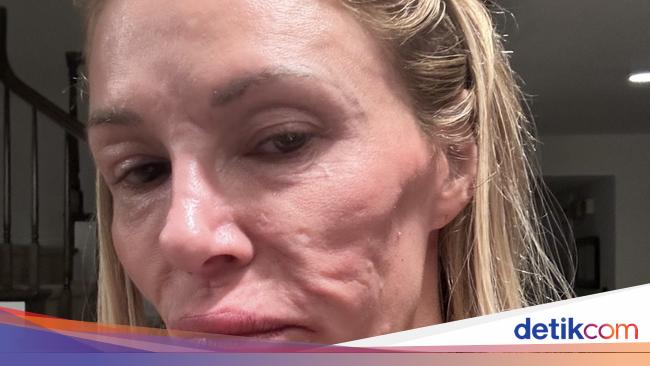 Wajah Penyok karena Parasit, Bintang Reality Show Ini Puasa Bercinta