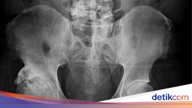 Man’s Penis Hardens and Turns ‘Bony’ in Rare Condition