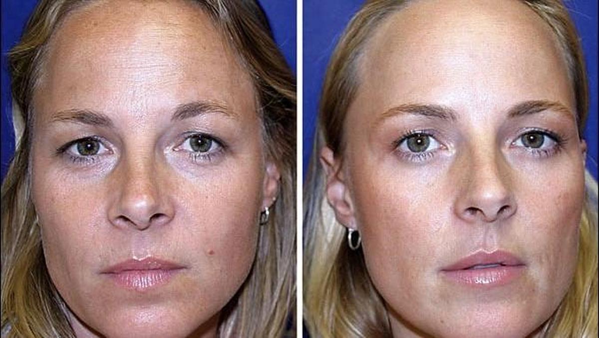 Botox Mahal Ini Saudari Kembar Ini Jalani Eksperimen Botox, Bisa Tebak Mana yang Melakukan?